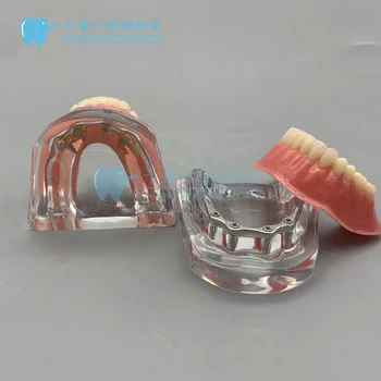 Diş ağız modeli Gümüş çubuk kart onarım Yarım ağız implant restorasyon modeli model beyin dikim için altın kutup kartları